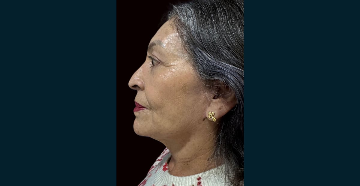 4-despuesLifting facial