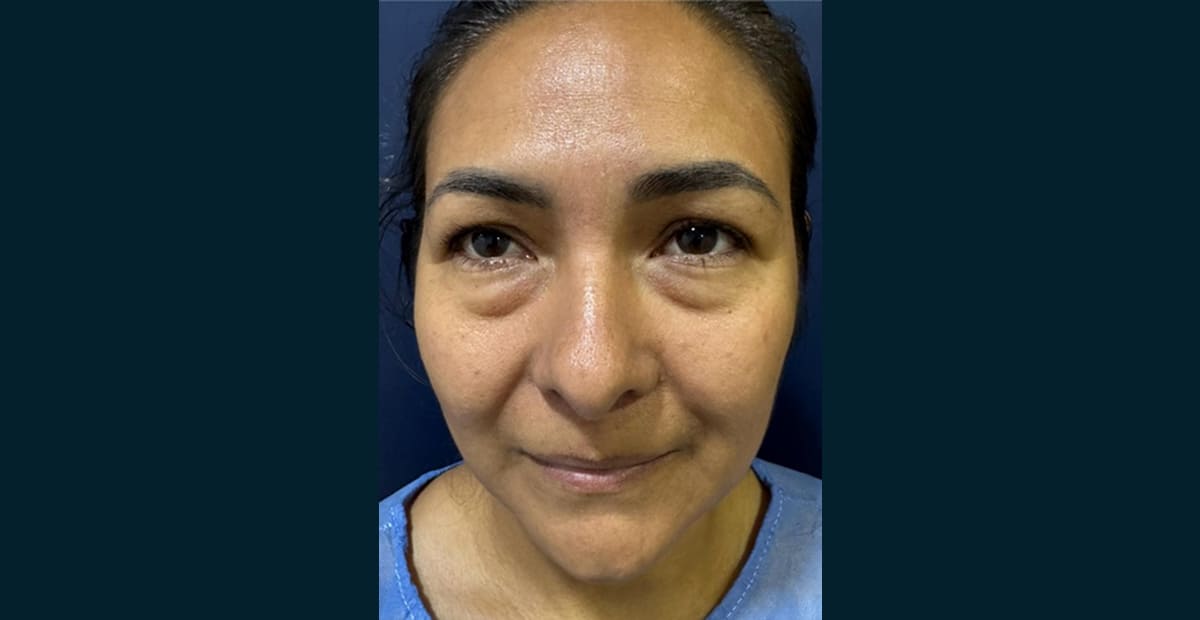 5-antes-bleforoplastia
