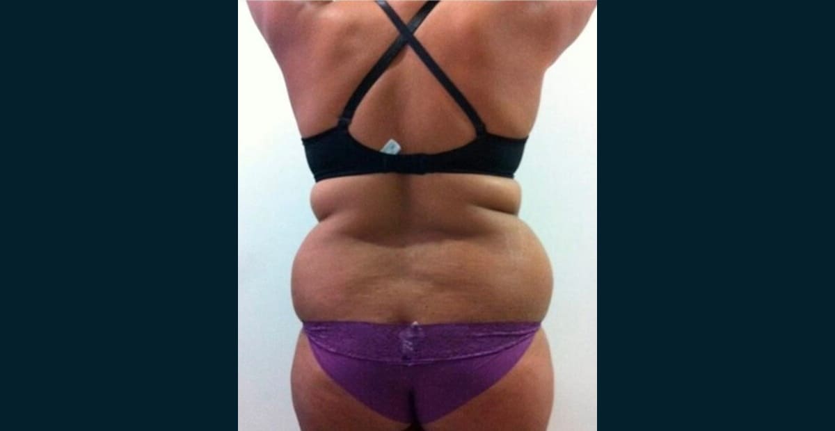 5-antes-liposuccion