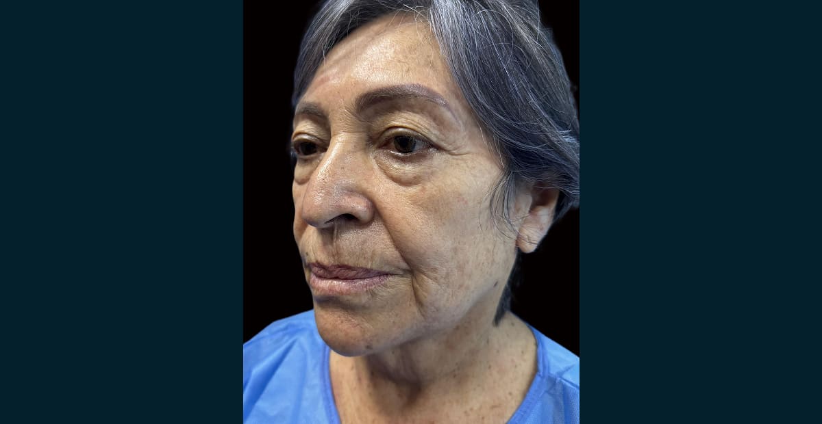 5-antesLifting facial