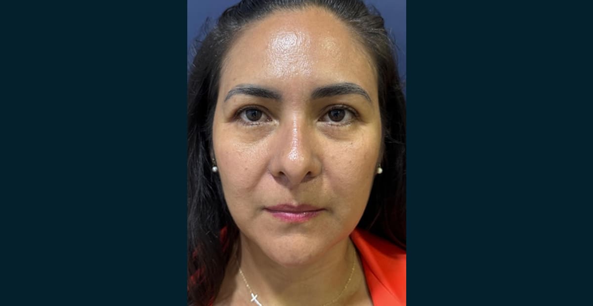 5-despues-bleforoplastia