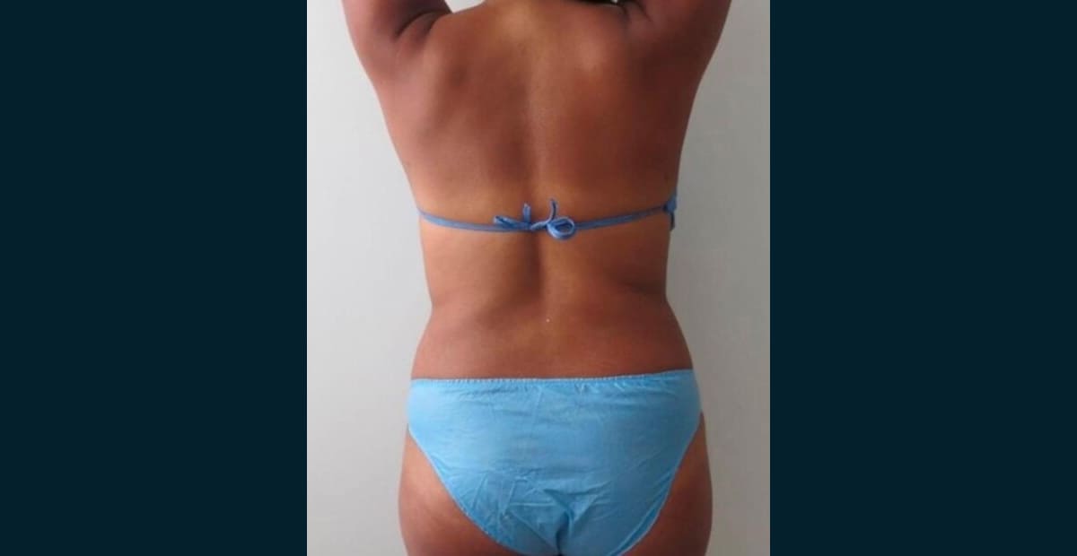 5-despues-liposuccion