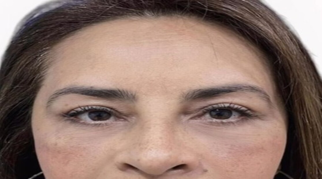 blefaroplastia 6 pop