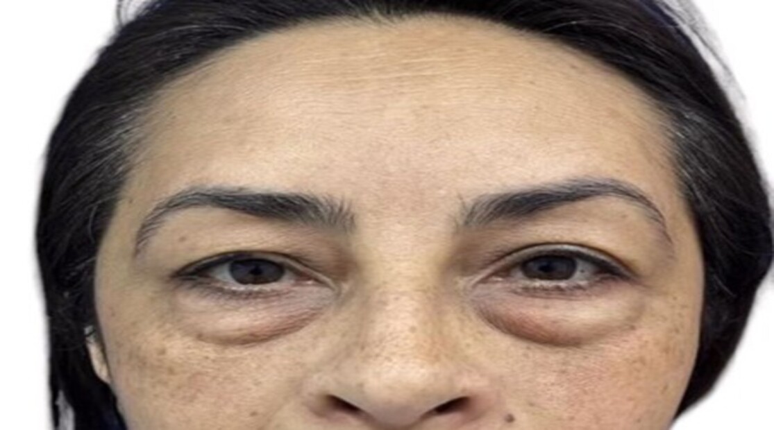 blefaroplastia 6 pre (1)