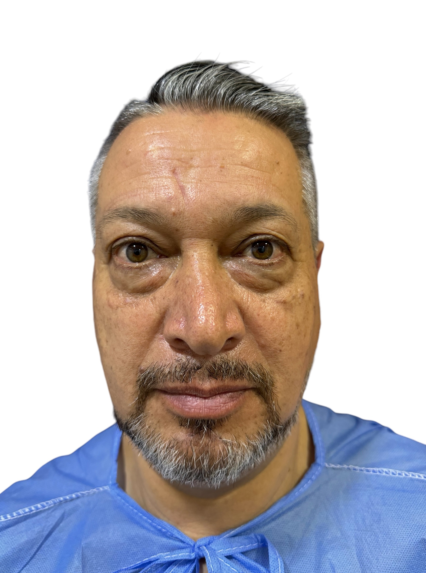 blefaroplastia-caso-1-antes