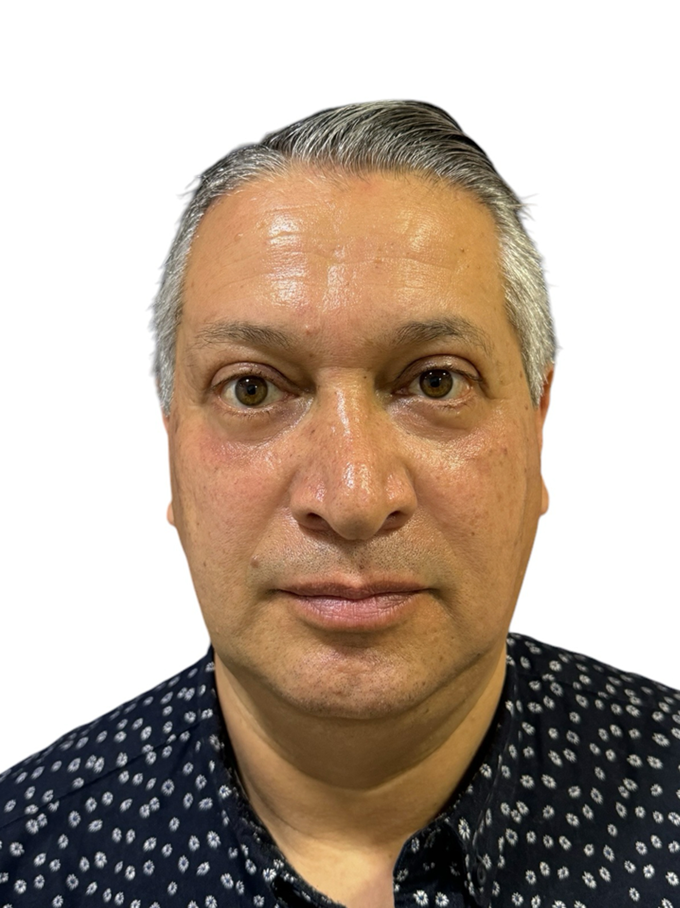 blefaroplastia-caso-1-despues