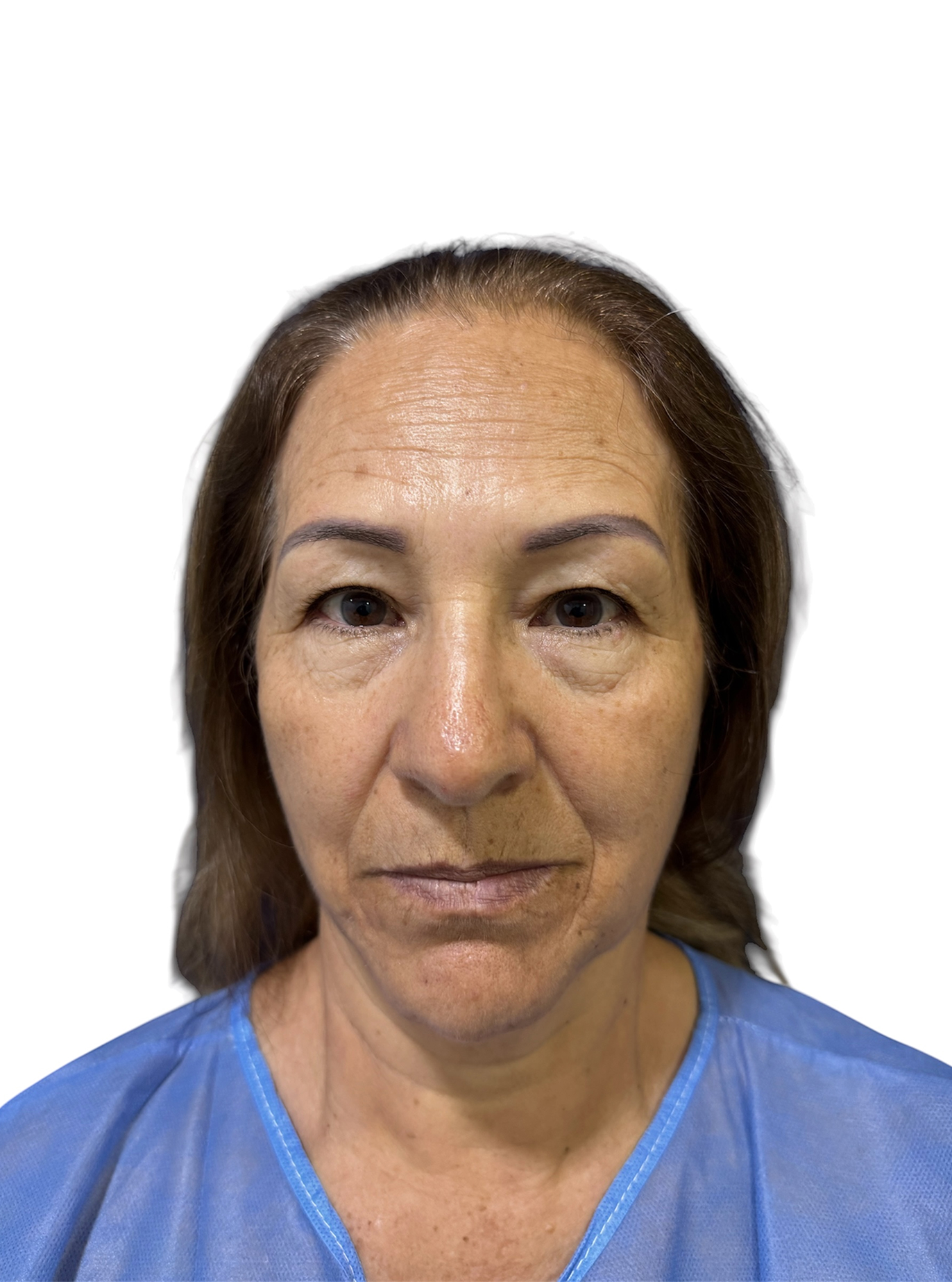 blefaroplastia-caso-2-antes