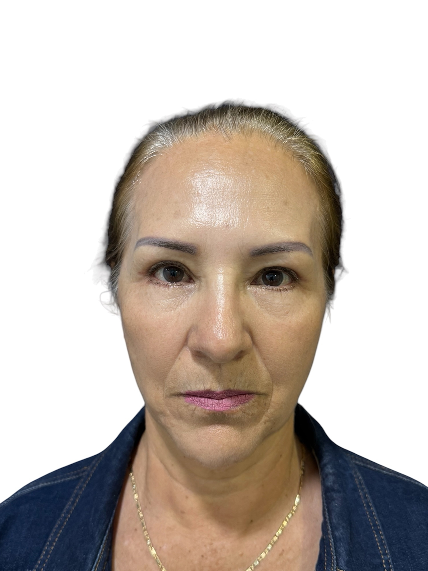 blefaroplastia-caso-2-despues