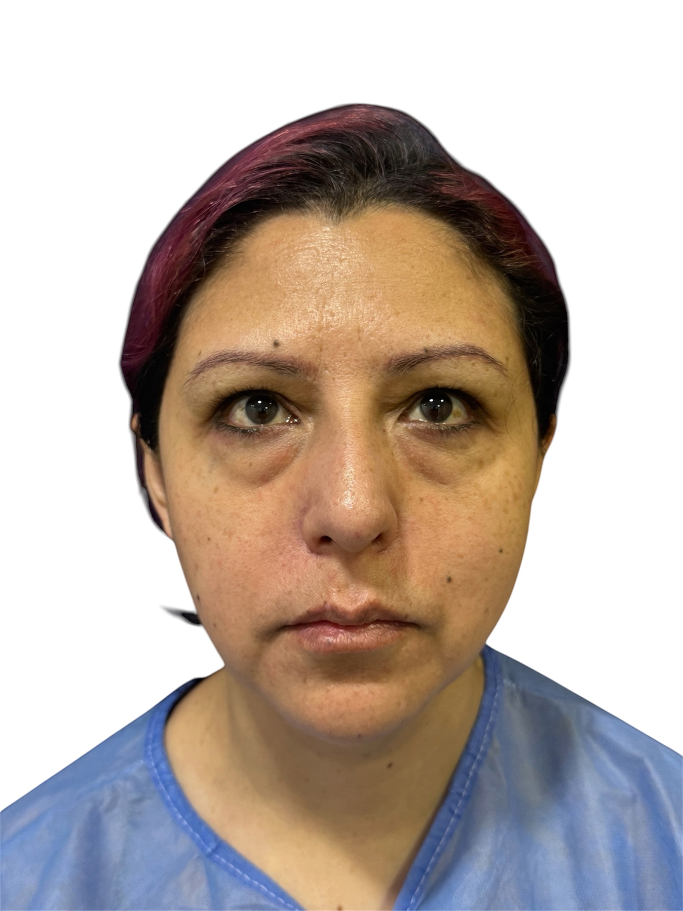 blefaroplastia-caso-3-antes