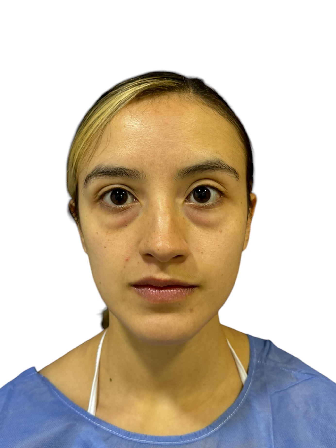blefaroplastia-caso-4-antes