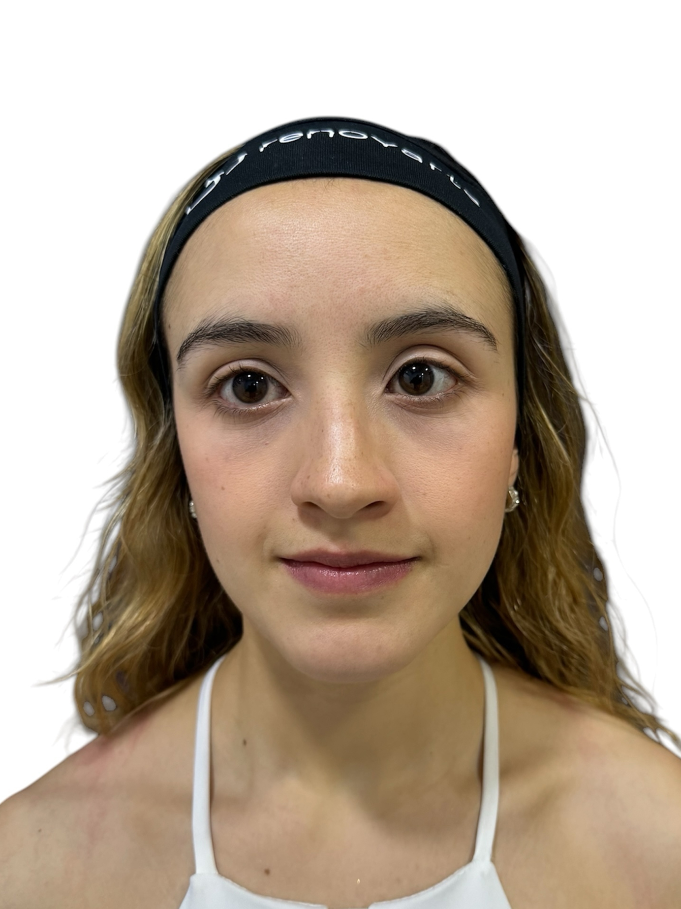 blefaroplastia-caso-4-despues