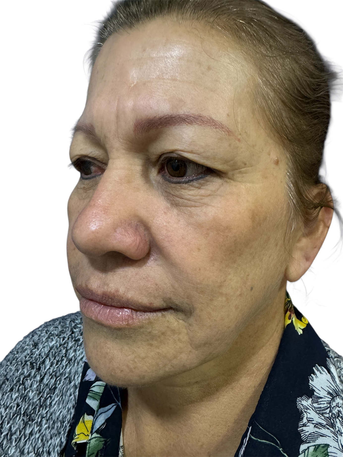 blefaroplastia-caso-5-antes