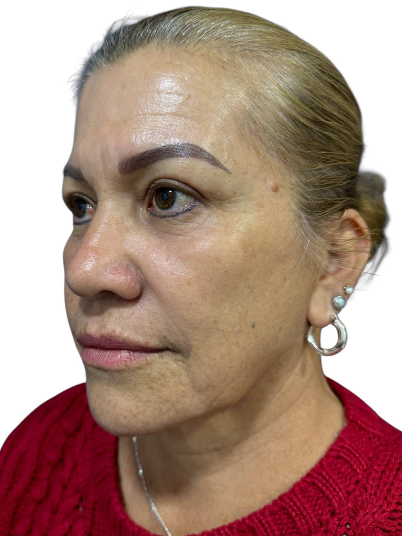 blefaroplastia-caso-5-despues