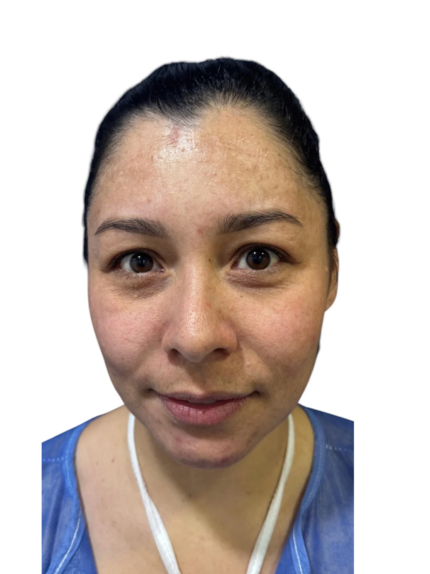 blefaroplastia-caso-6-antes