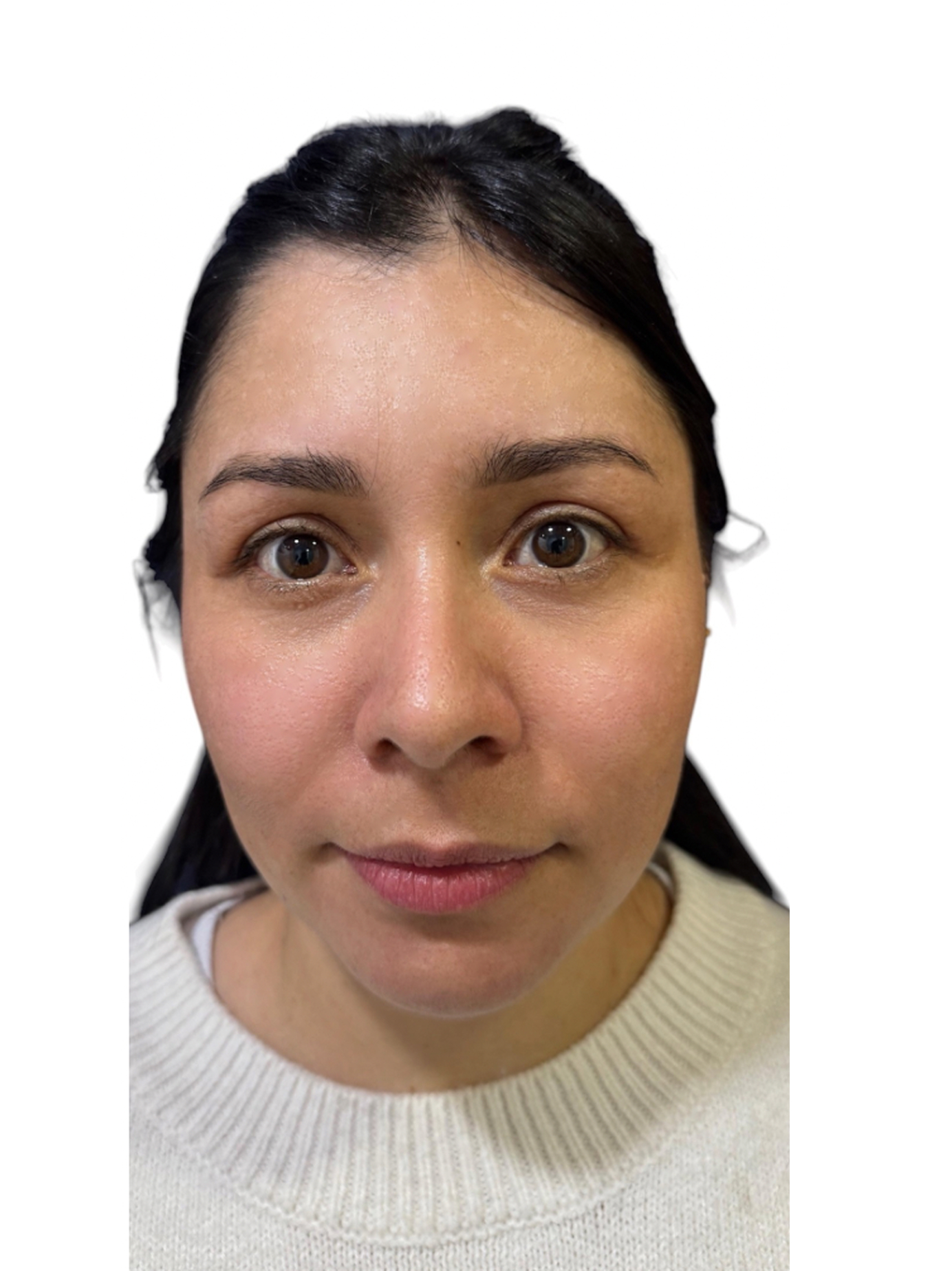 blefaroplastia-caso-6-despues