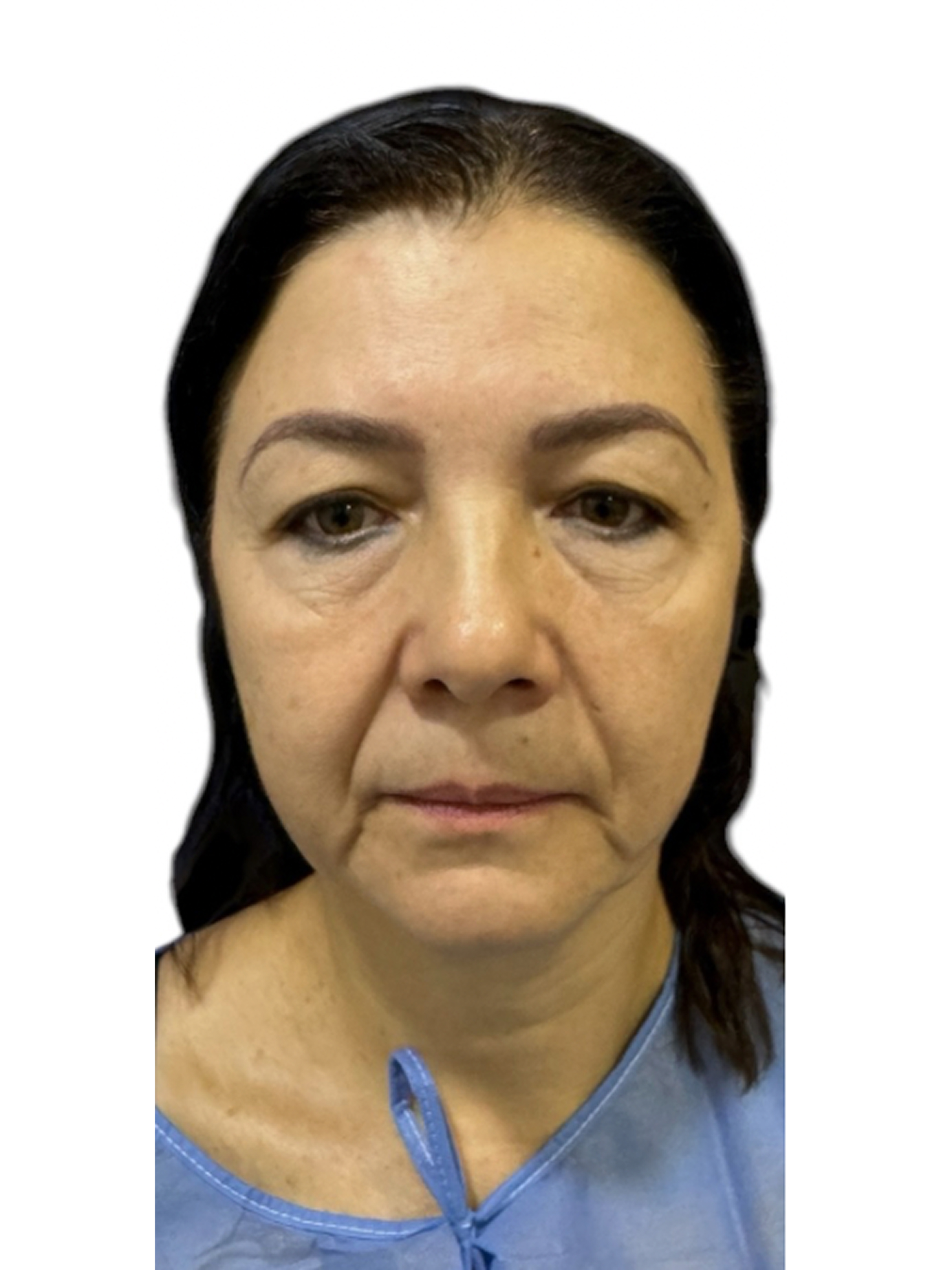 blefaroplastia-caso-7-antes
