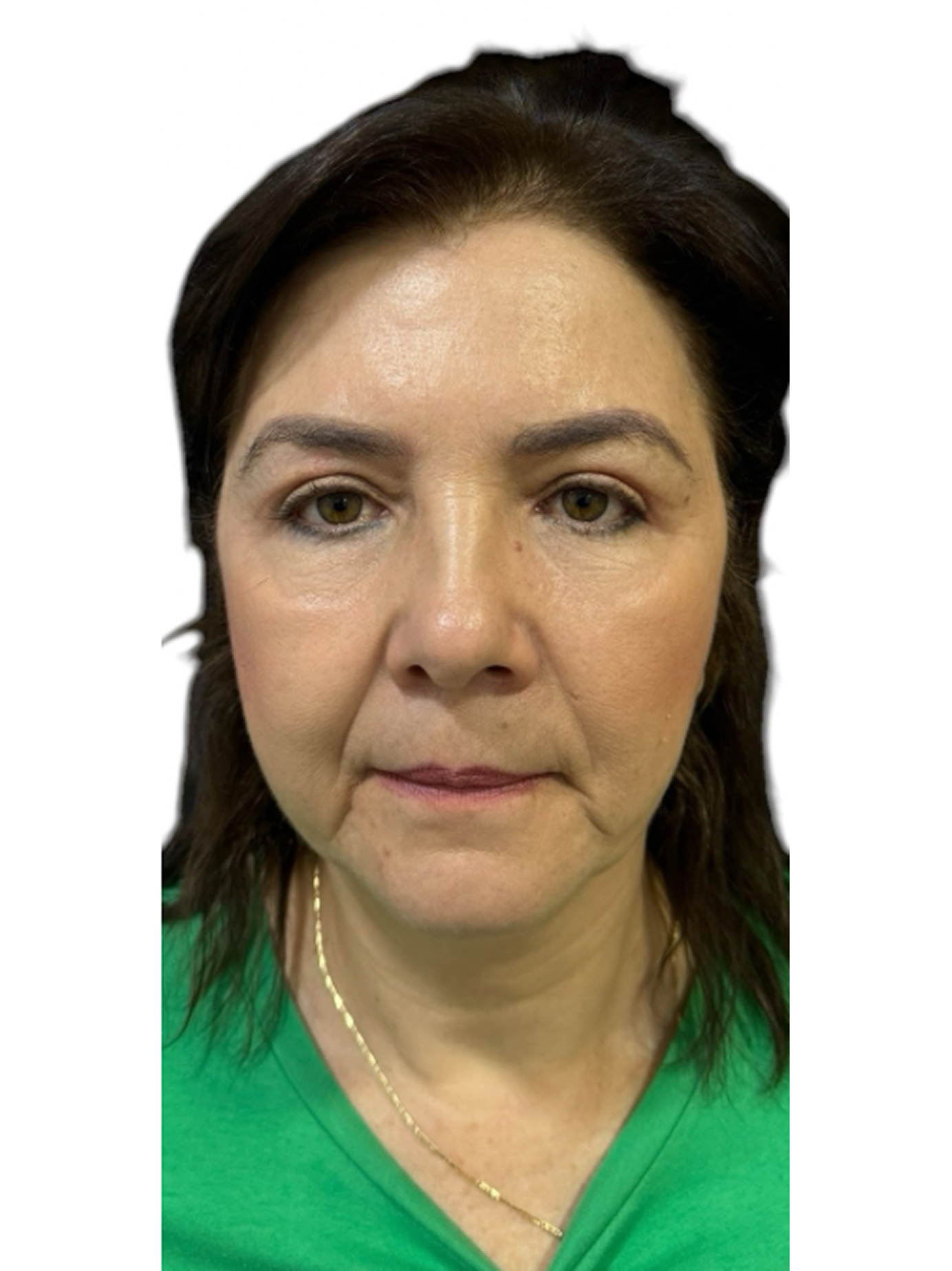 blefaroplastia-caso-7-despues